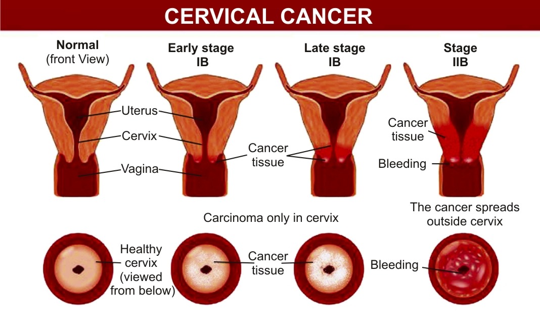 cancerul uterin al virusului papiloma uman