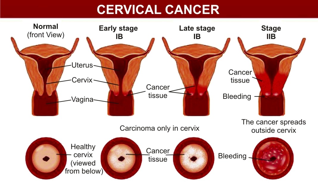 a hpv vírus nem 16 vagy 18)